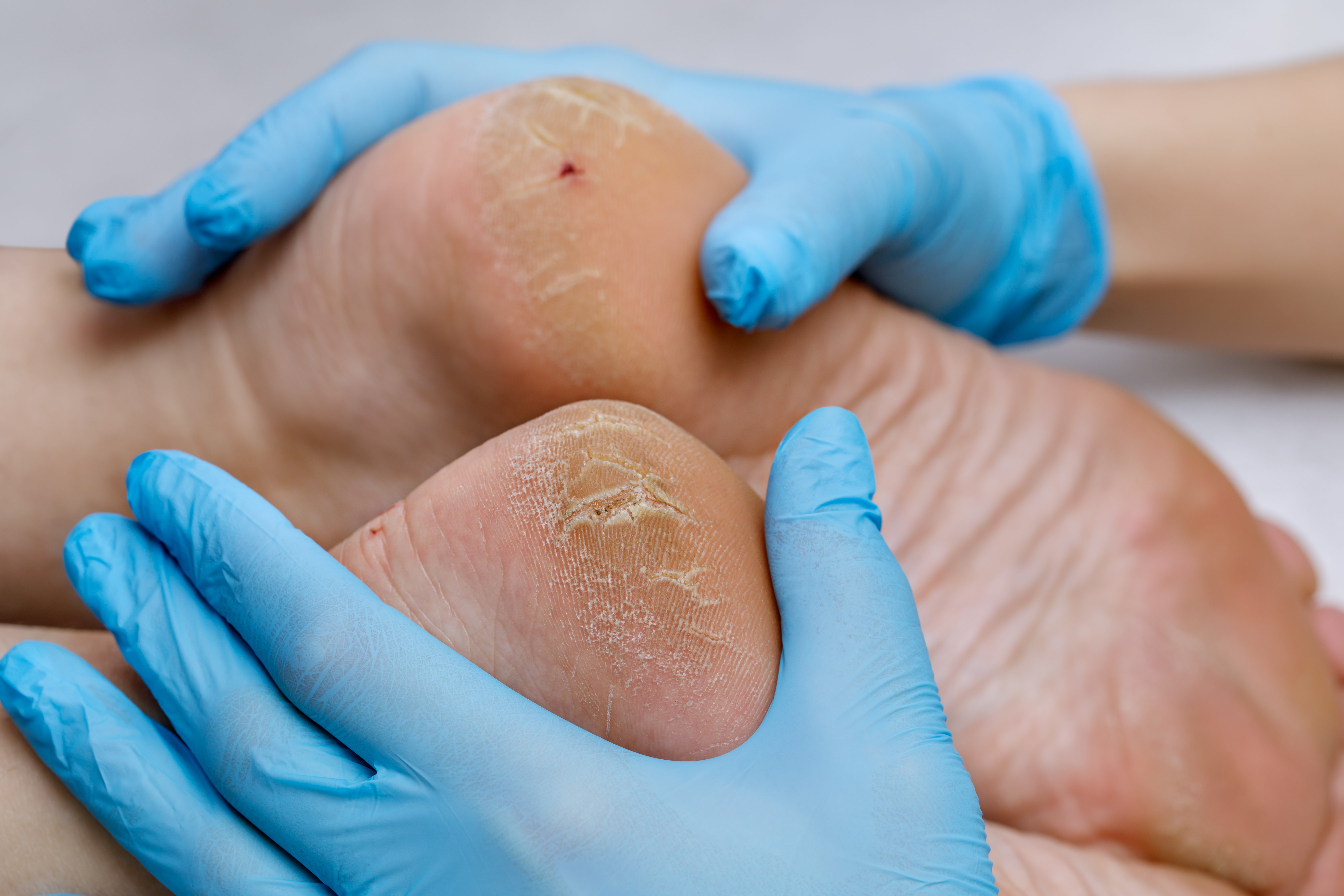 Foot care nurse examining heels of the feet